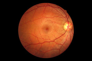 Retina Example